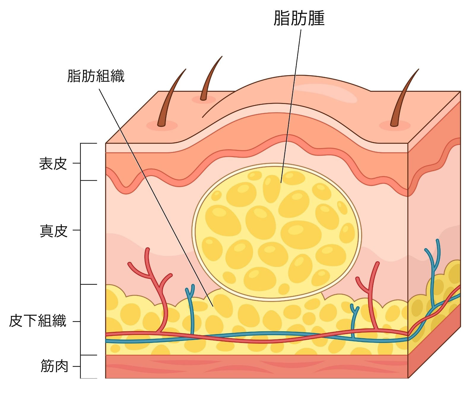脂肪腫